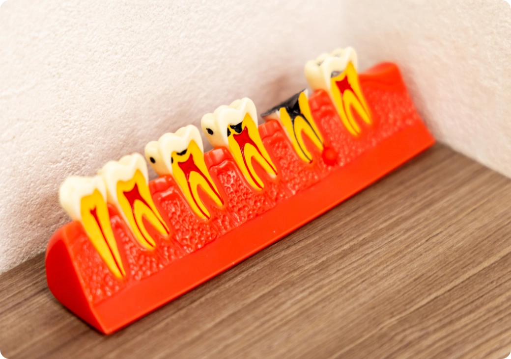 お子さまの歯の治療